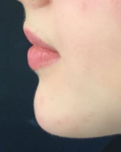 Chin Filler London