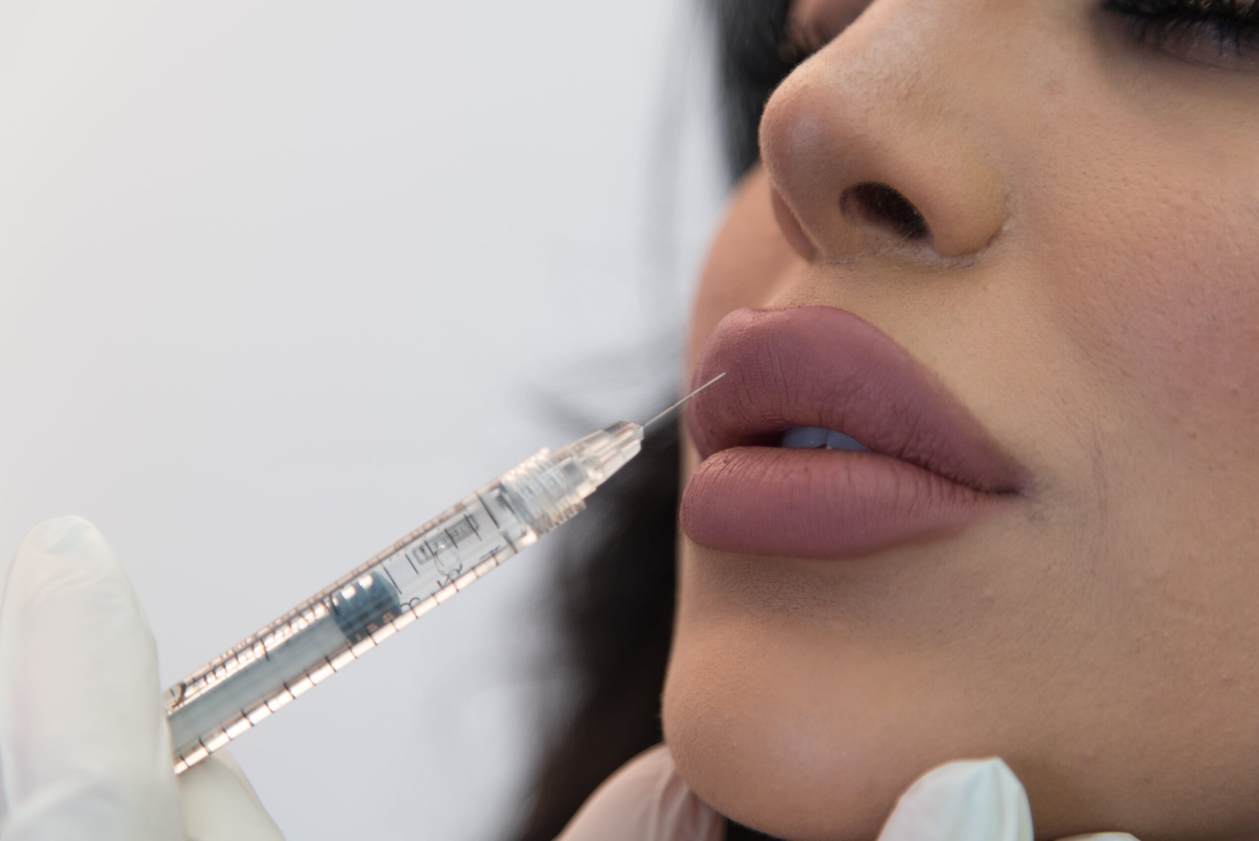 Lip Fillers London