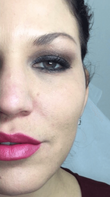 Cheek Enhancement
