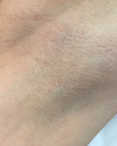 Hair Removal Treatment