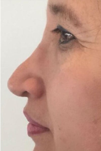 Non Surgical Rhinoplasty Treatments London