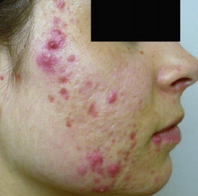 acne treatment laser