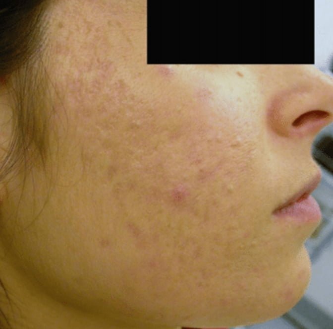 acne laser treatment