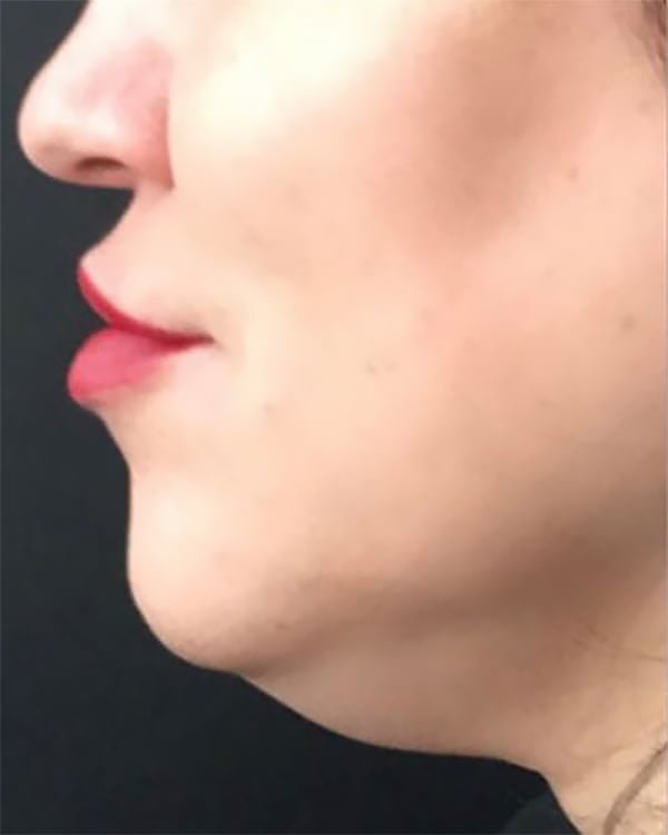 aqualyx injection double chin