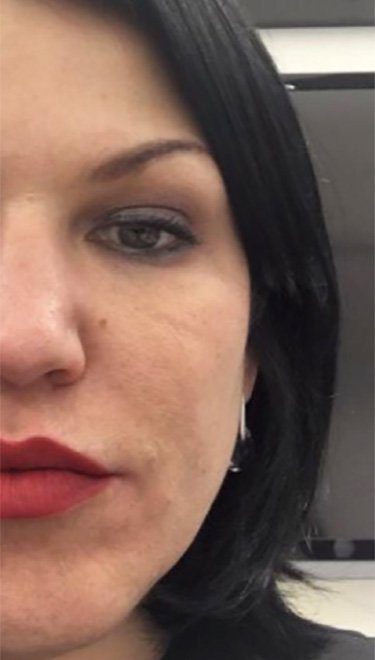 cheek enhancement with dermal filler injection