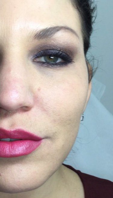 cheek dermal filler injection