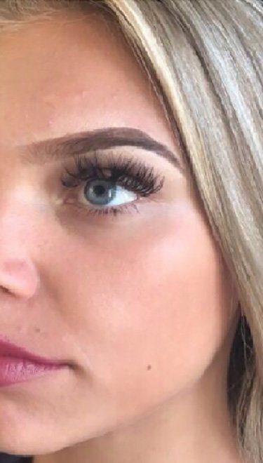 cheek dermal filler injection