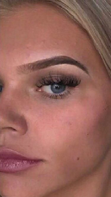 cheek dermal filler injection