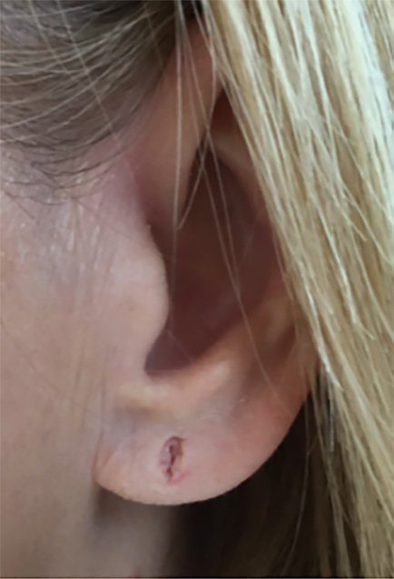 earlobe hole repair