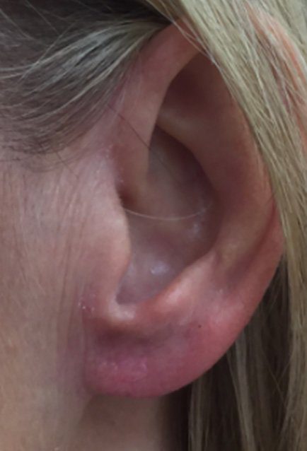 ear piercing hole closing