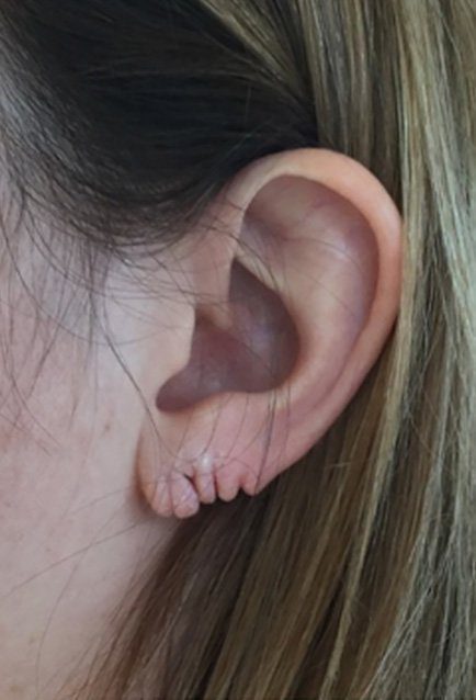 split earlobe repair