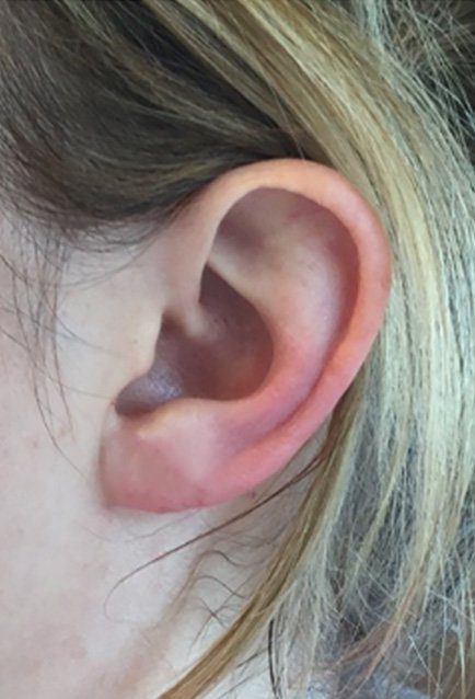 split earlobe repair