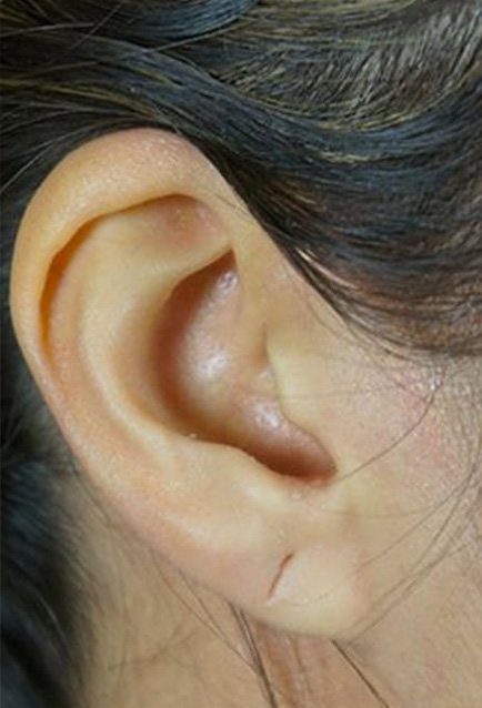 split earlobe repair