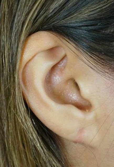 split earlobe repair