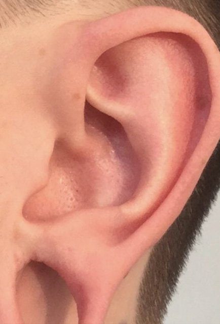 ear piercing hole closing