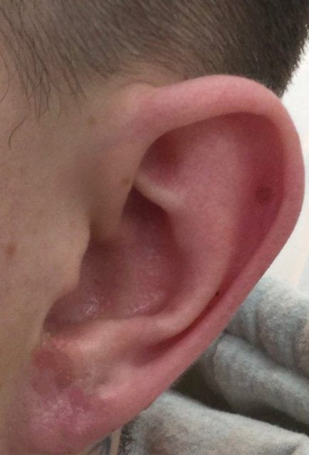 earlobe repair treatment
