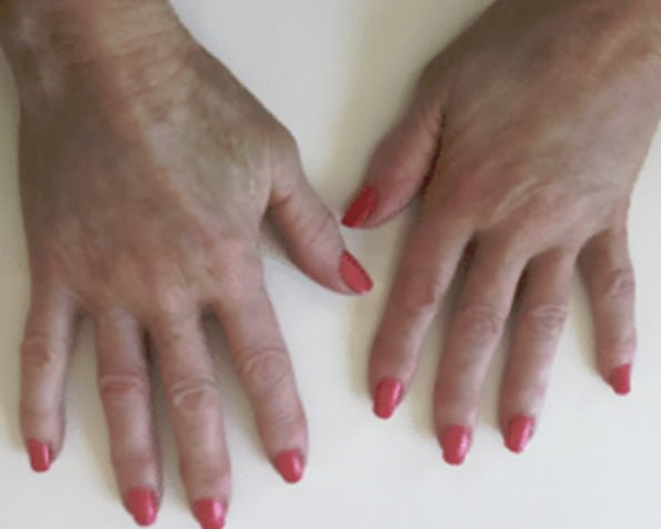 dermal filler for hand