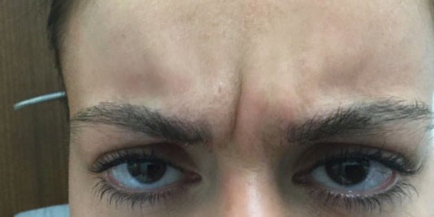 dermal filler injection for frown lines