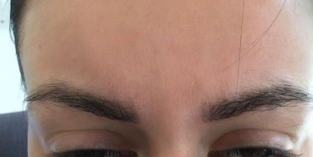 frown lines dermal filler treatment