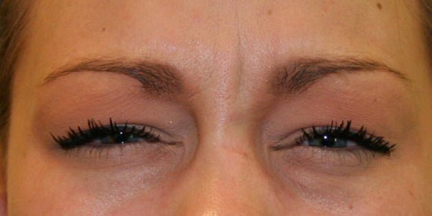 frown lines botox injection