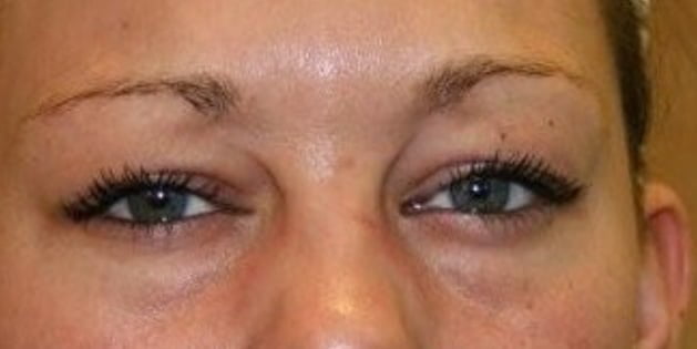 botox injection for frown lines