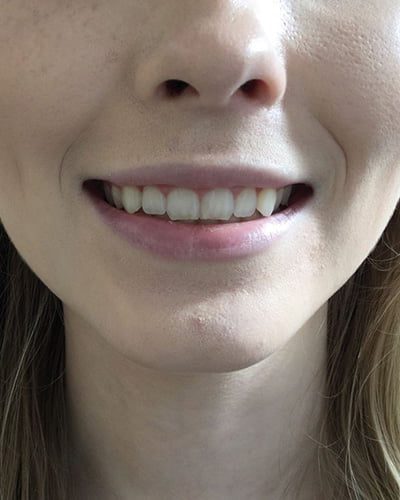 gummy smile botox treatment