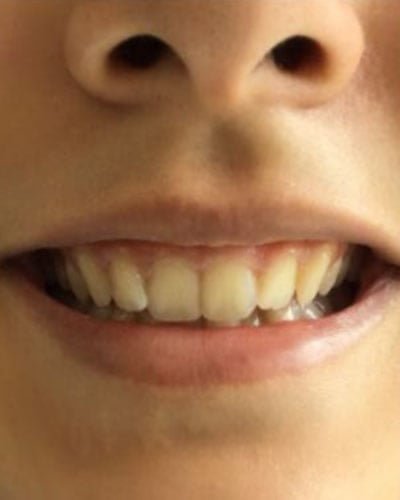 gummy smile treatment