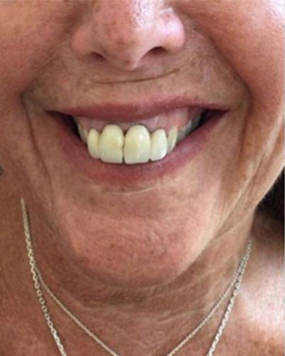 gummy smile botox injection