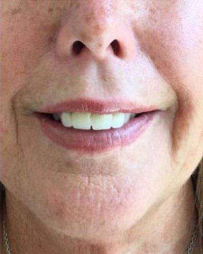 gummy smile treatment