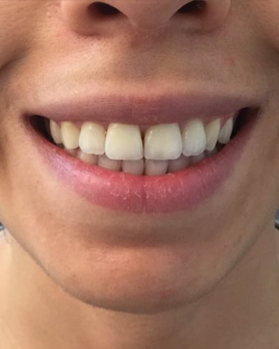 gummy smile botox injection