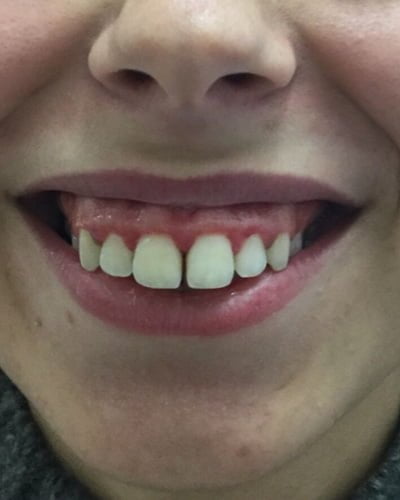 gummy smile botox injection