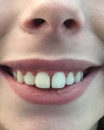 gummy smile botox injection