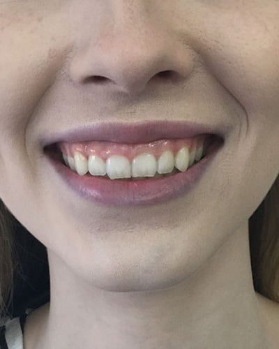 botox injection for gummy smile treatment