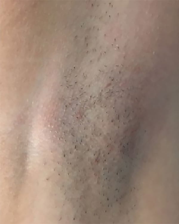 laser hair removal