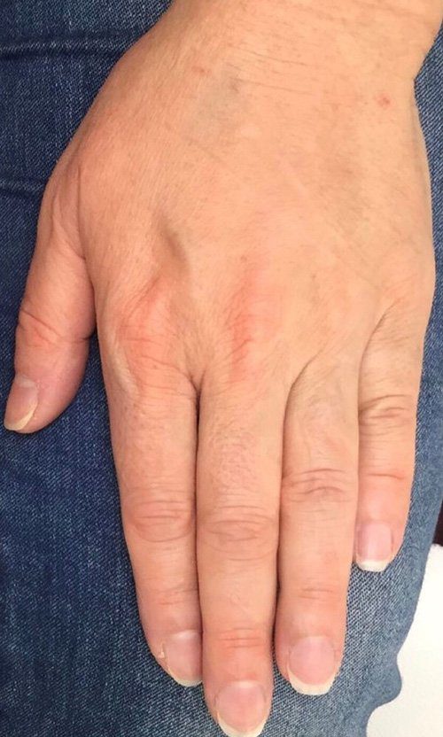 hand rejuvenation with dermal filler