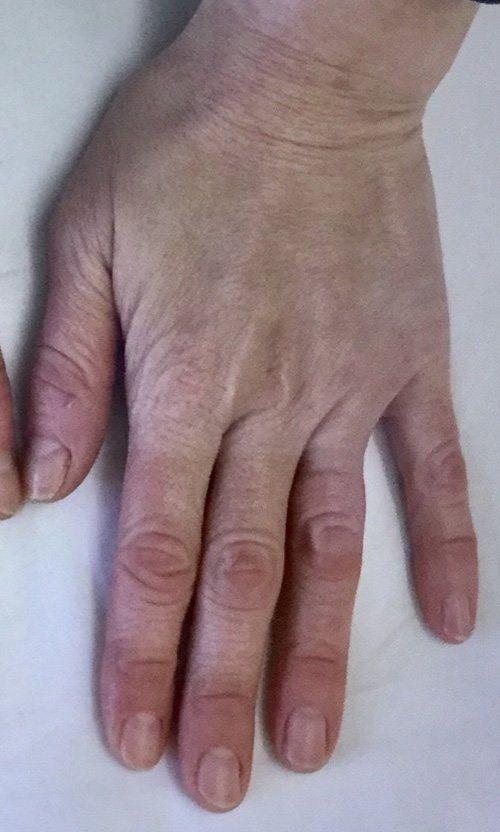 hand dermal filler