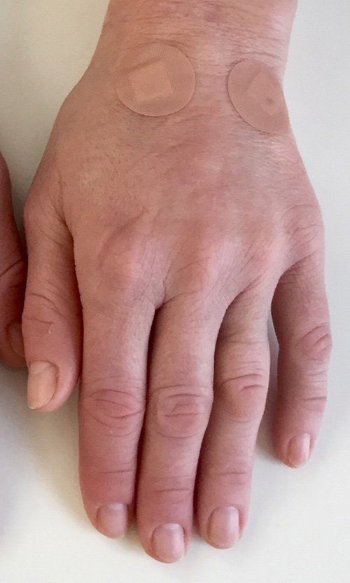 hand dermal filler
