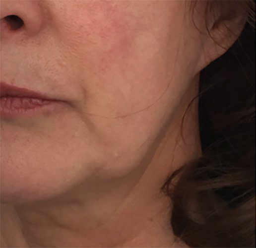 sagging jawline correction with dermal filler
