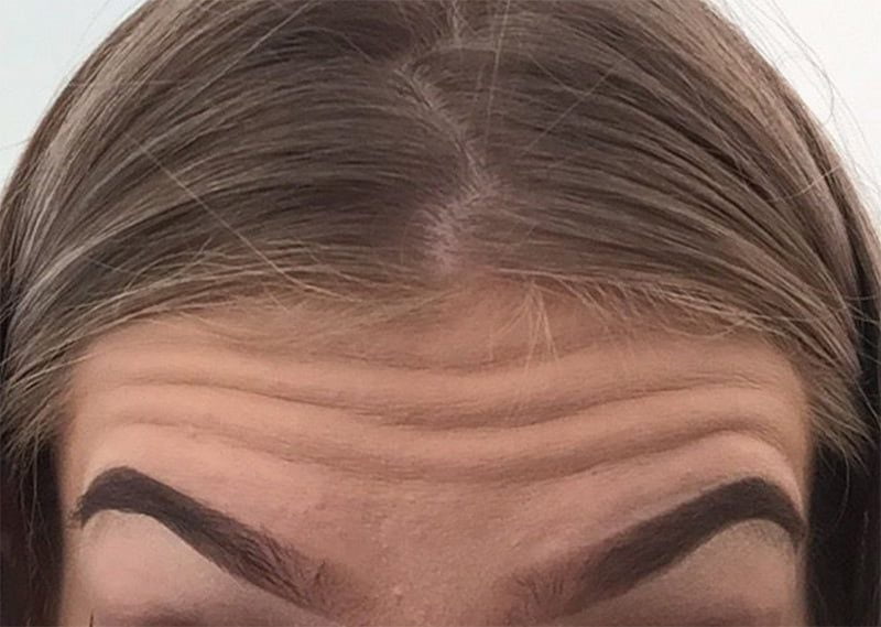 forehead wrinkles injection