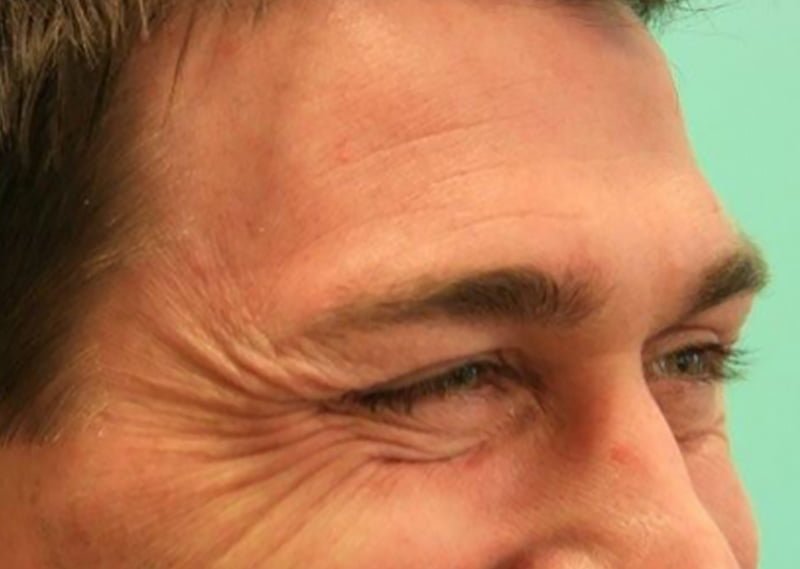 crow's feet botox injection