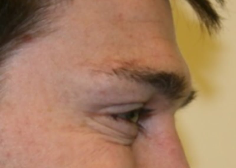 crow's feet lines botox injection
