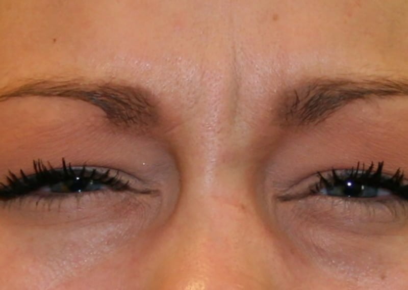 frown lines botox treatment