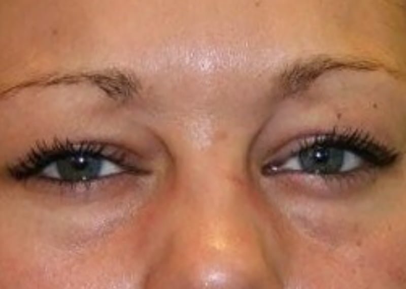 frown lines botox injection