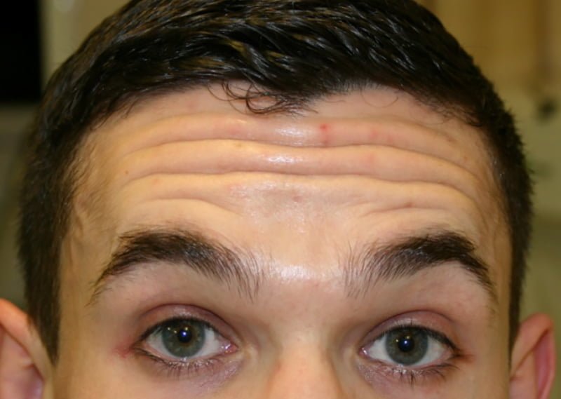 forehead wrinkles botox injection