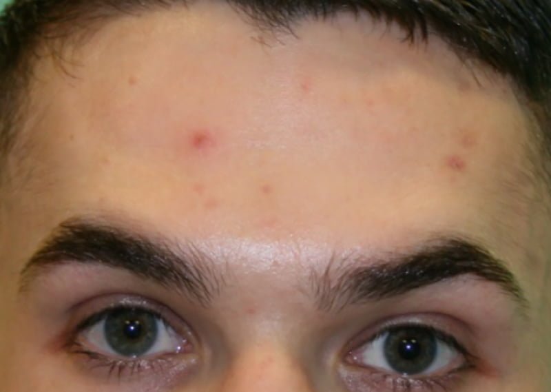 botox forehead lines