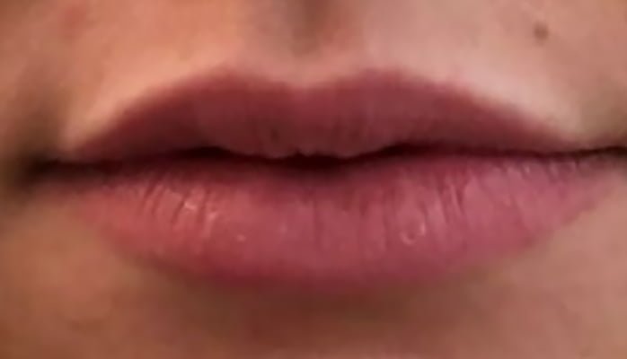 lips filler
