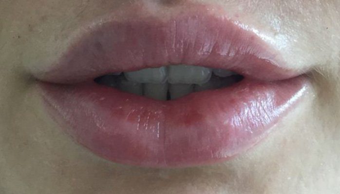 dermal filler lips