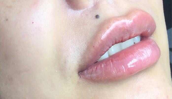 lips filler