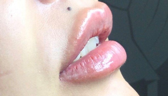dermal filler lips