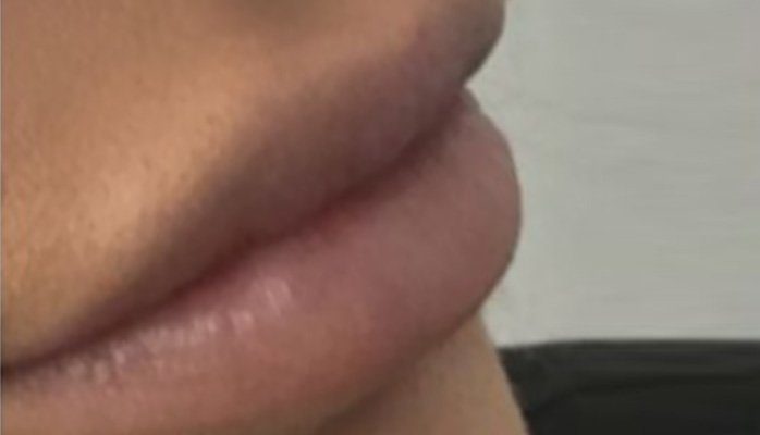 lips filler